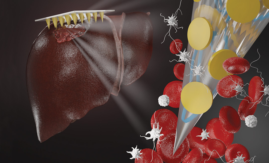 Graphic of microneedle patch repairing bleeding liver.